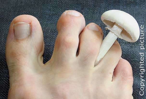 image de champignon entre les orteils - picture fungus between toe clefts